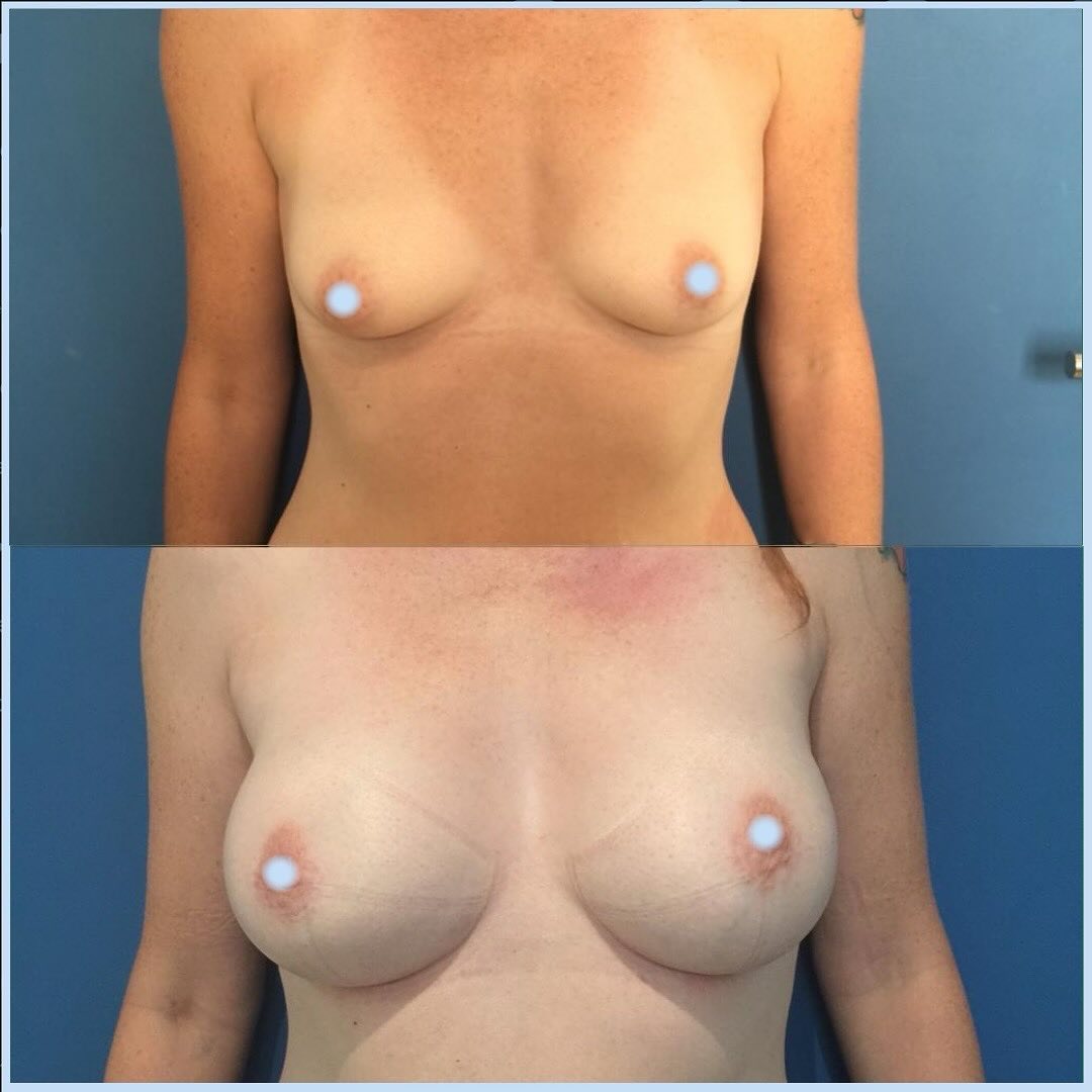 Augmentation-mammaire- protheses-3 Augmentation mammaire par prothèses