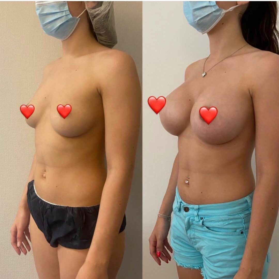 Augmentation mammaire par prothèses