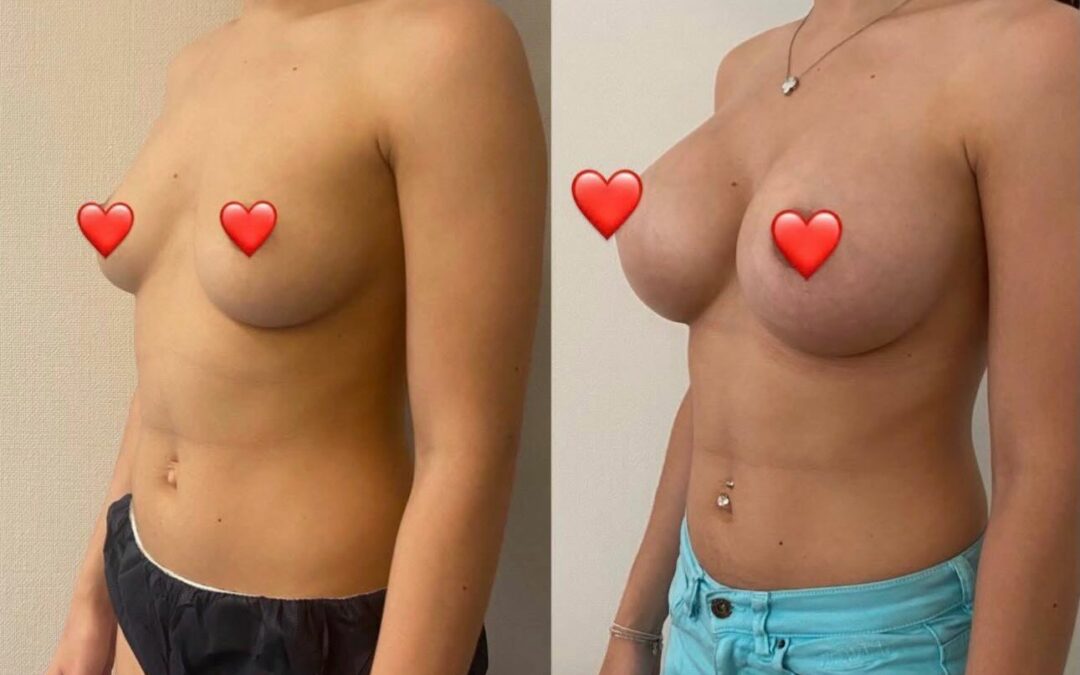 Augmentation des seins par prothèses