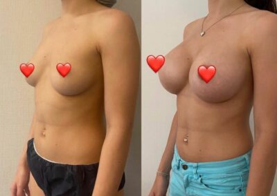Augmentation des seins par prothèses