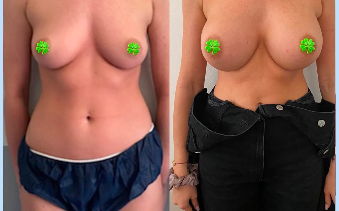 Augmentation mammaire par protheses