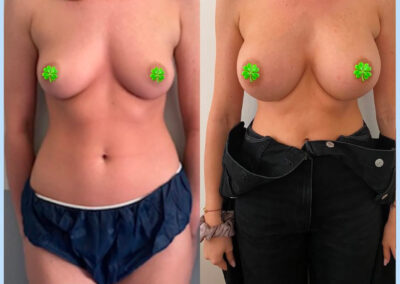 Augmentation mammaire par protheses