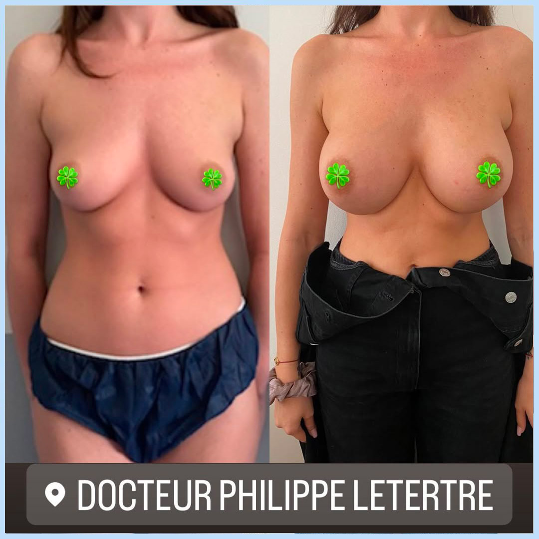 Augmentation-mammaire--protheses-7 Augmentation-mammaire- protheses