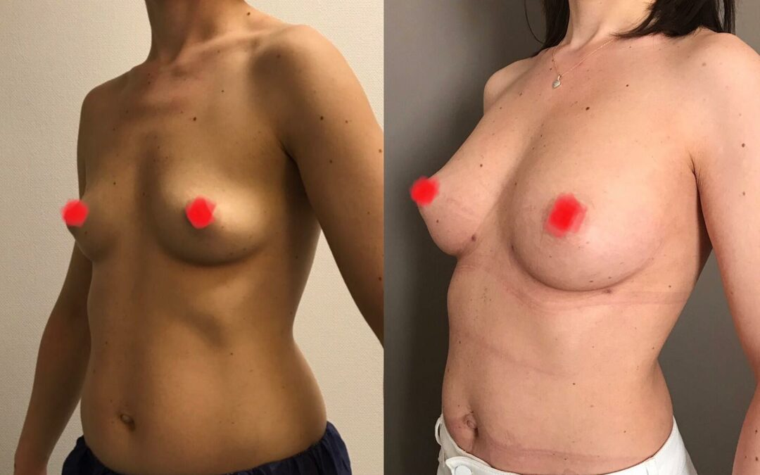 Lipofilling des seins