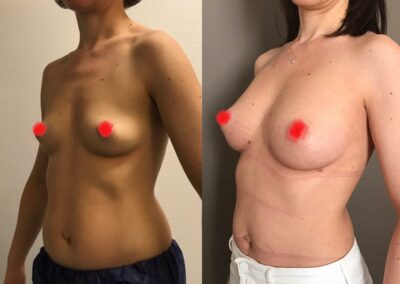 Lipofilling des seins