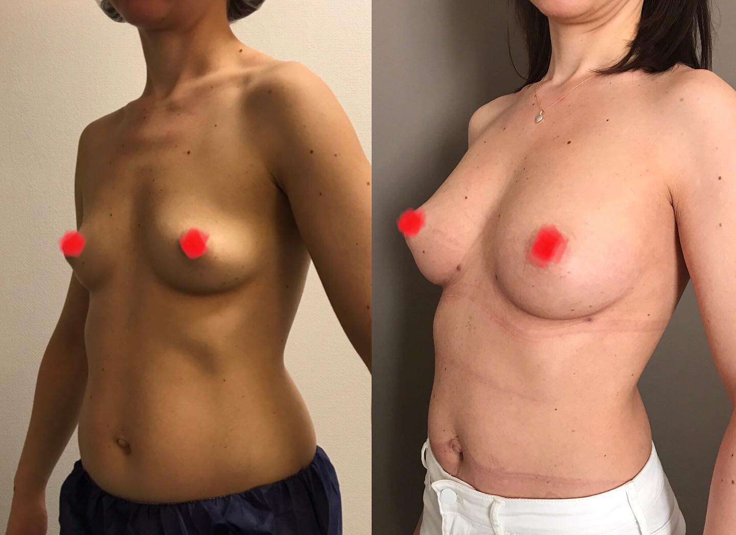Lipofilling-1 Lipofilling des seins, Nice, Philippe Letertre