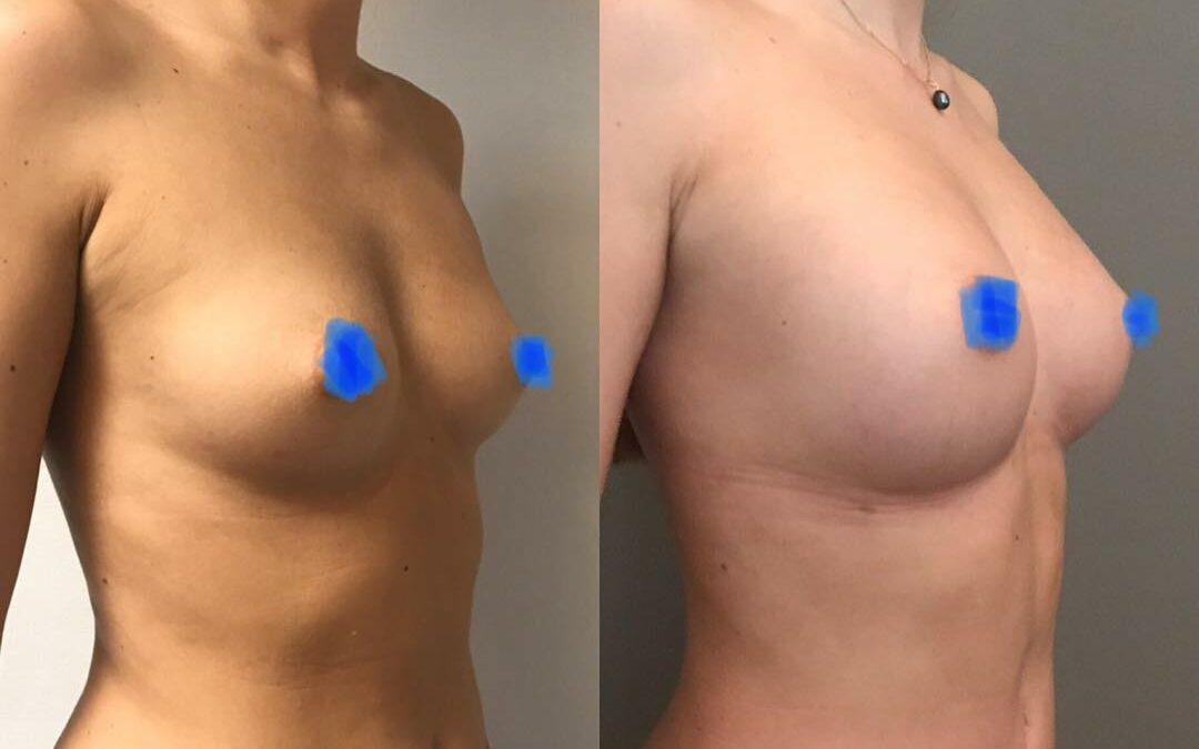 Lipofilling des seins