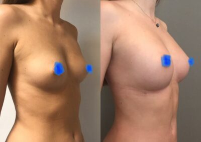 Lipofilling des seins