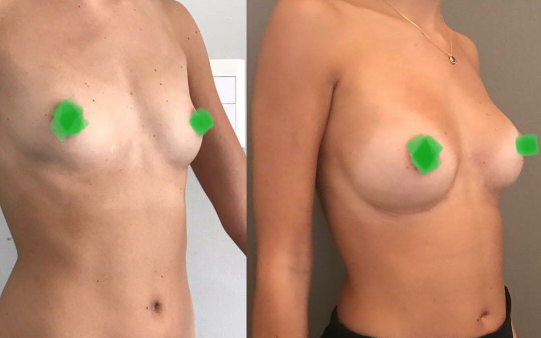 Lipofilling des seins