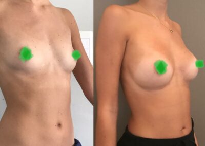 Lipofilling des seins