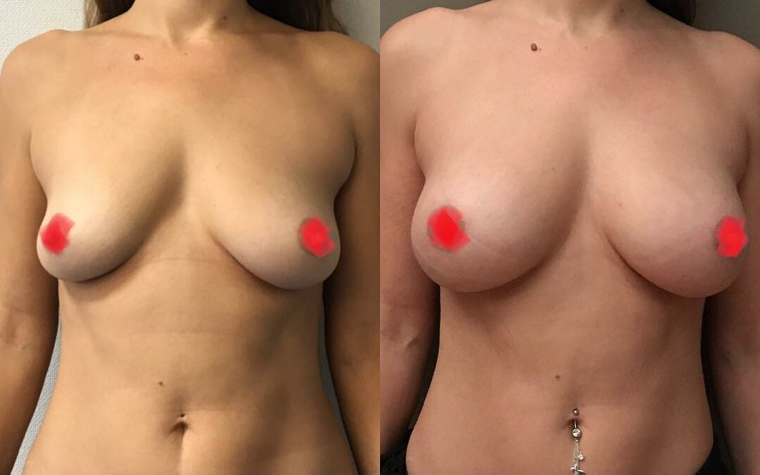 Lipofilling des seins
