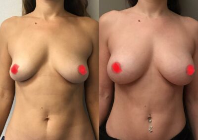 Lipofilling des seins