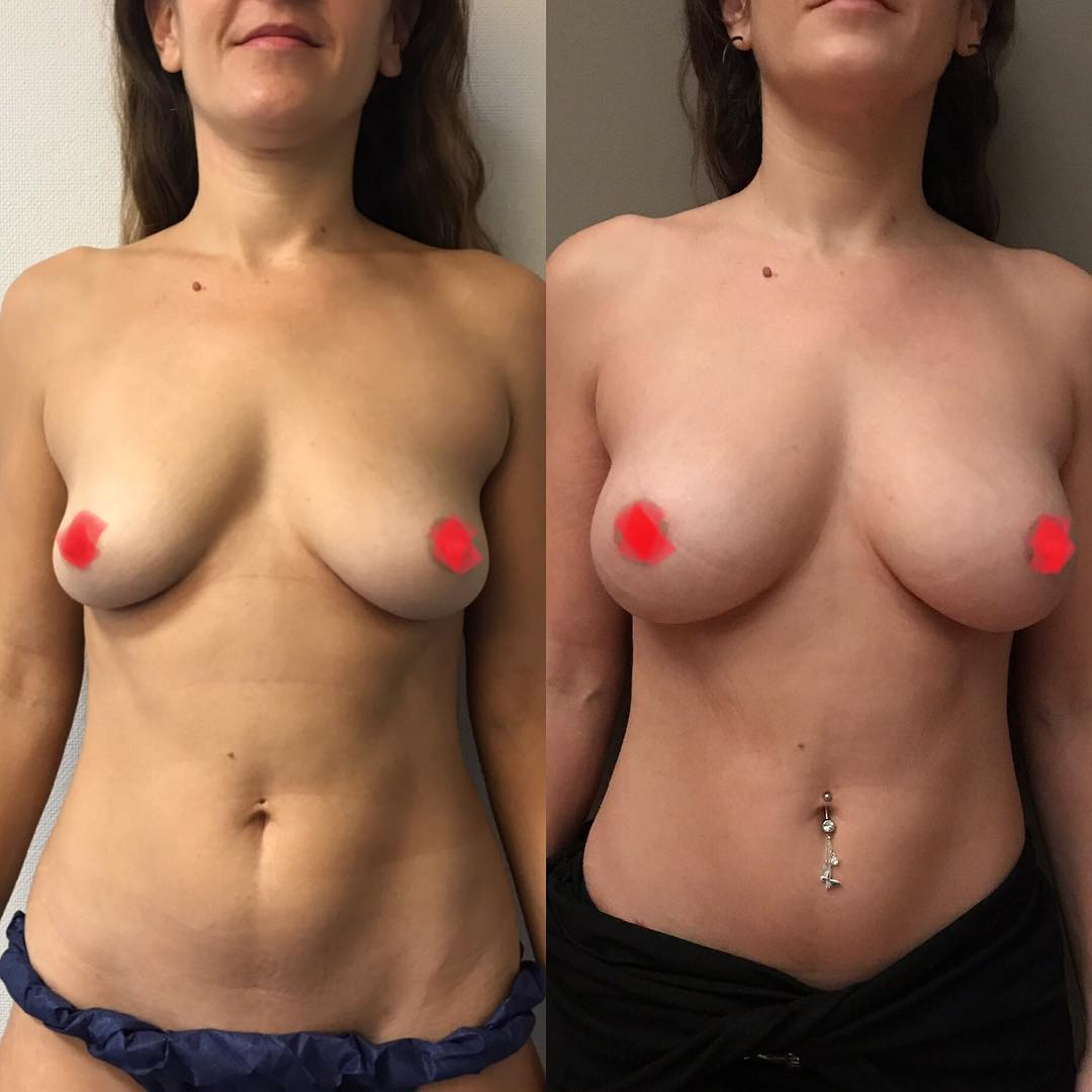 Lipofilling-4 Lipofilling des seins, Nice, Philippe Letertre