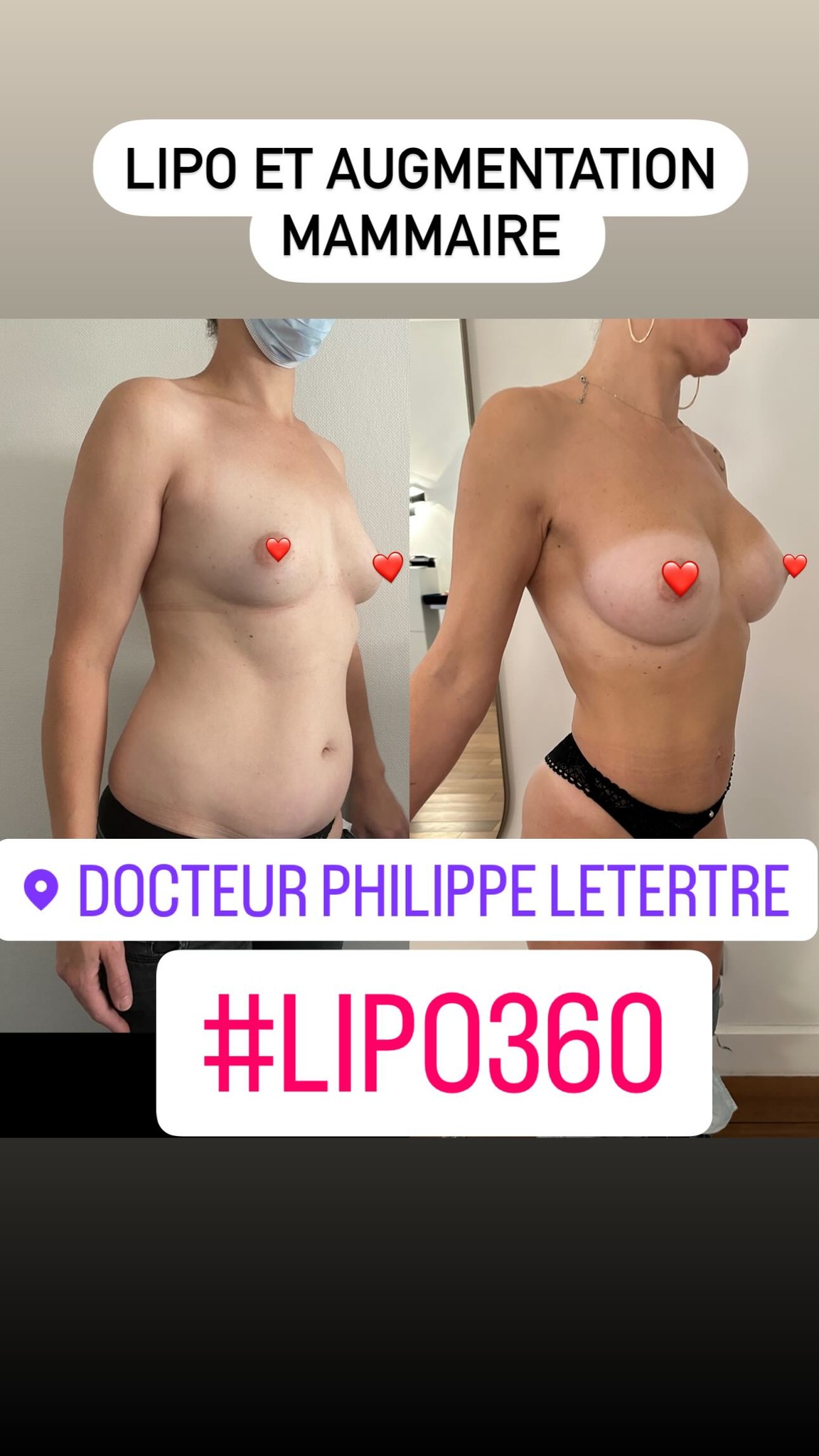 Lipofilling des seins, Nice, Philippe Letertre
