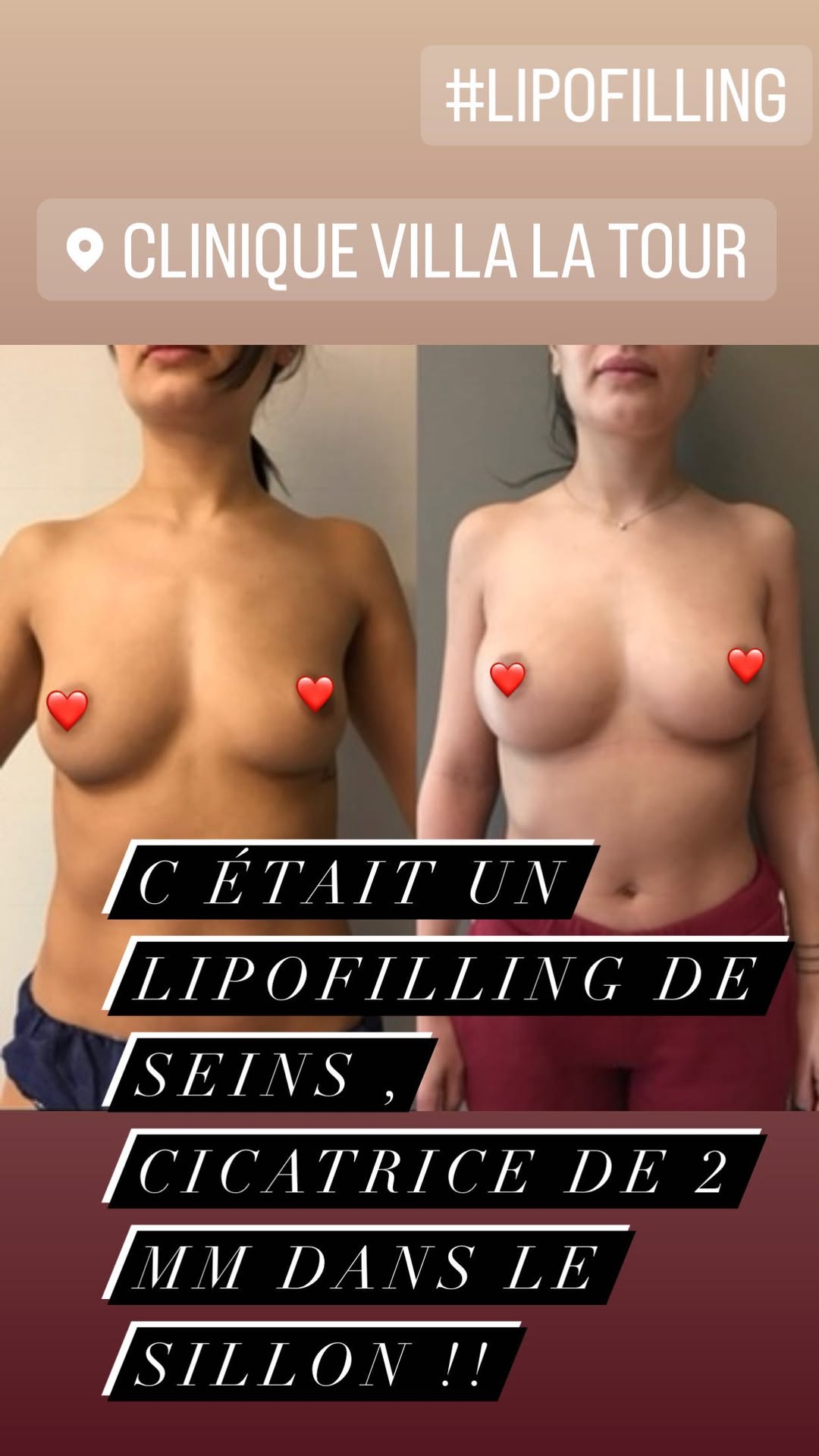 Lipofilling des seins, Nice, Philippe Letertre