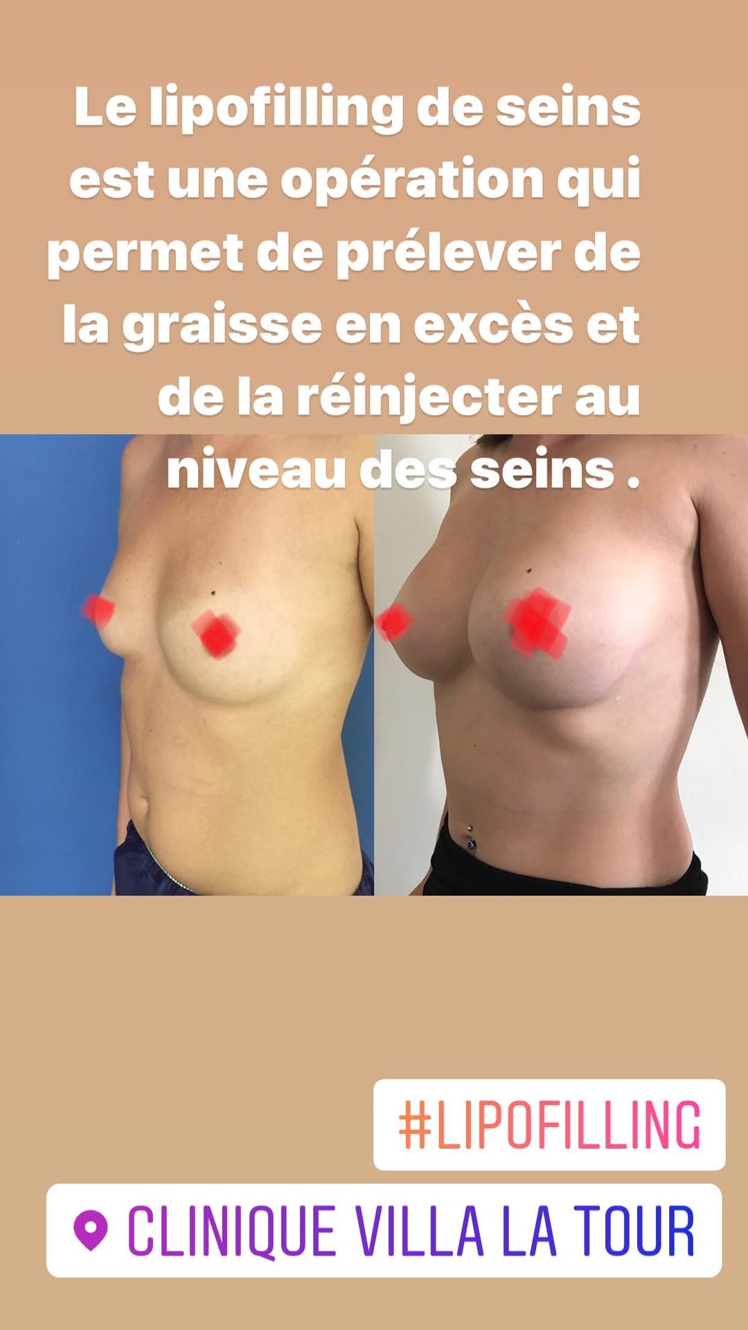 Lipofilling des seins, Nice, Philippe Letertre