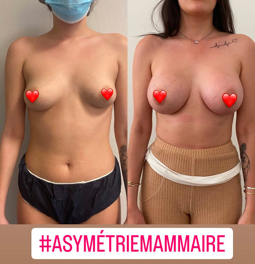 asymetrie-mammaire Asymétrie mammaire