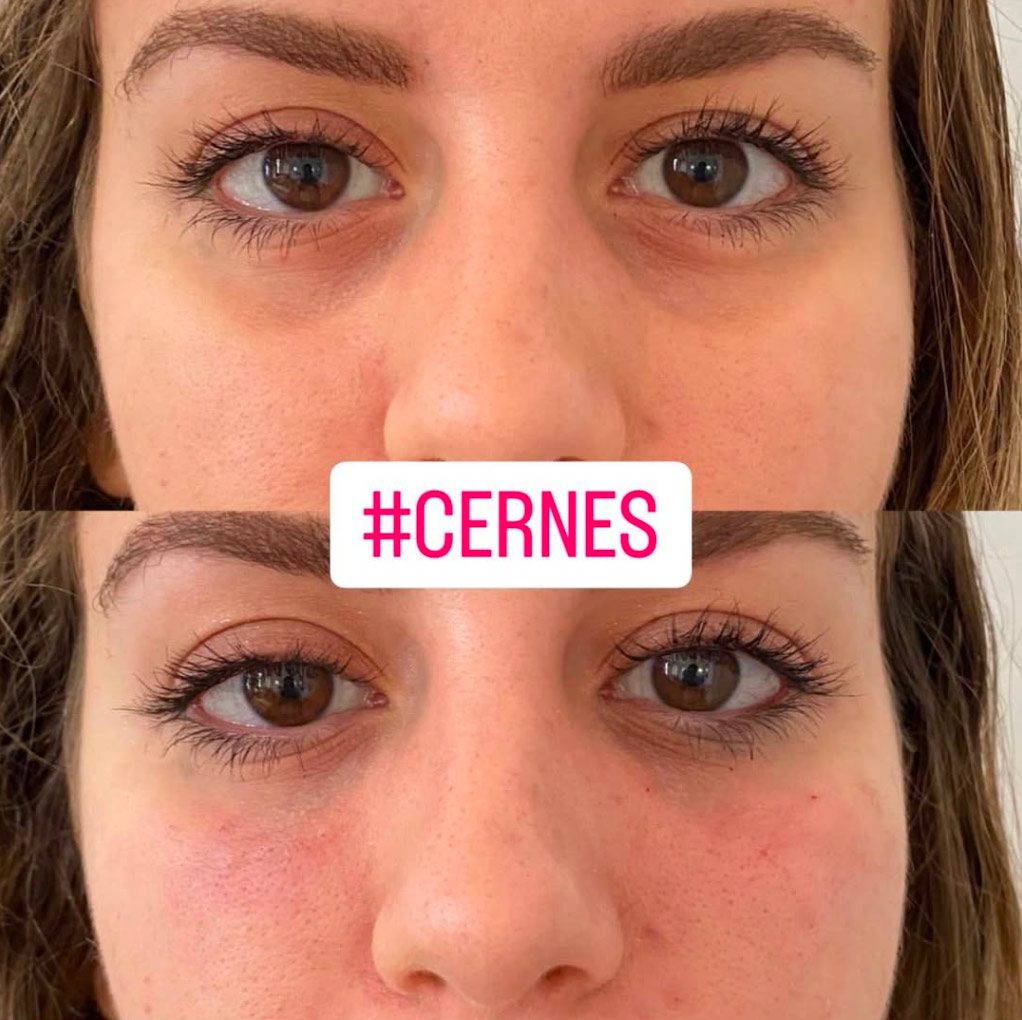 cernes Cernes avec Acide hyaluronique