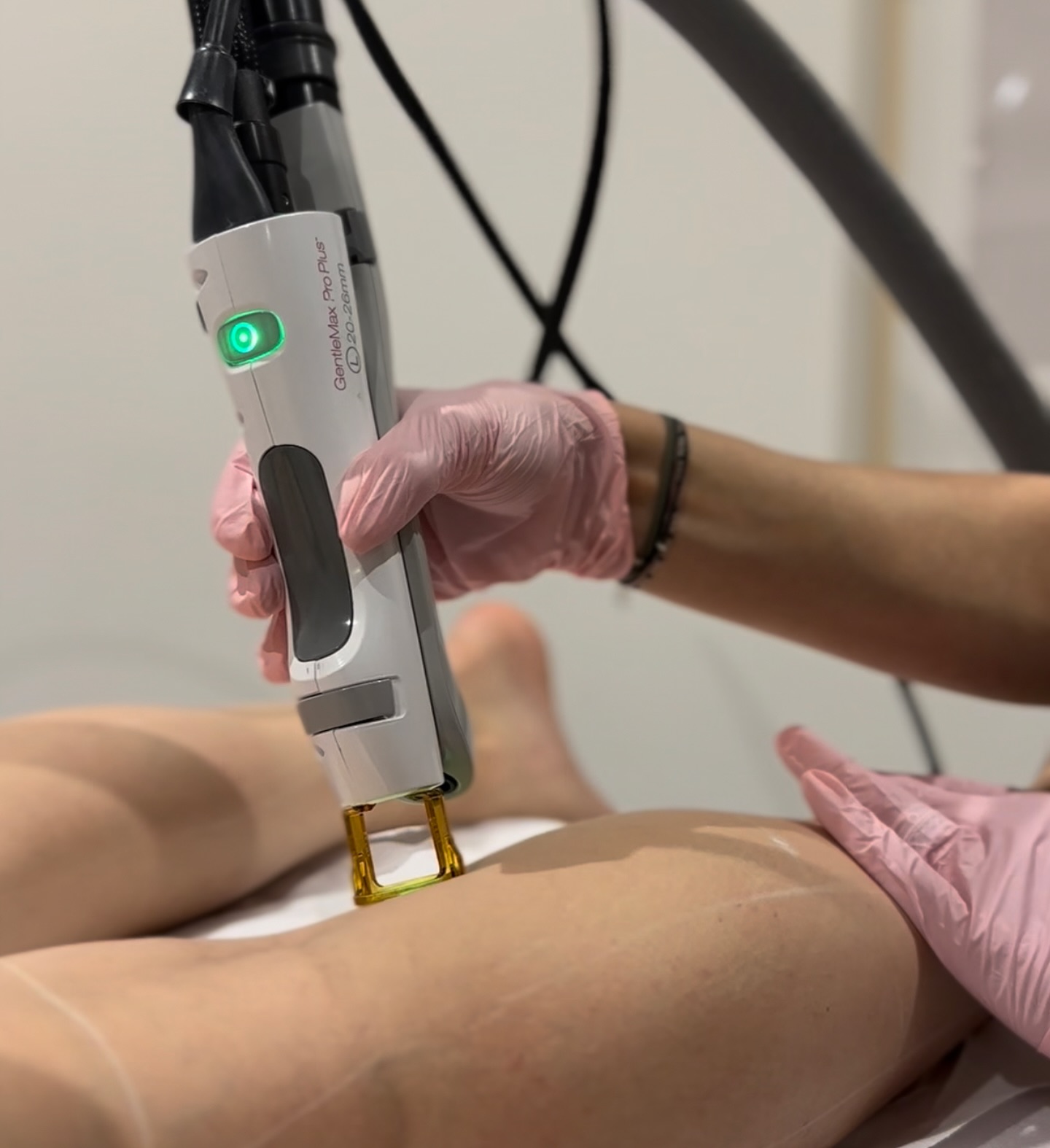 epilation-laser Laser épilation