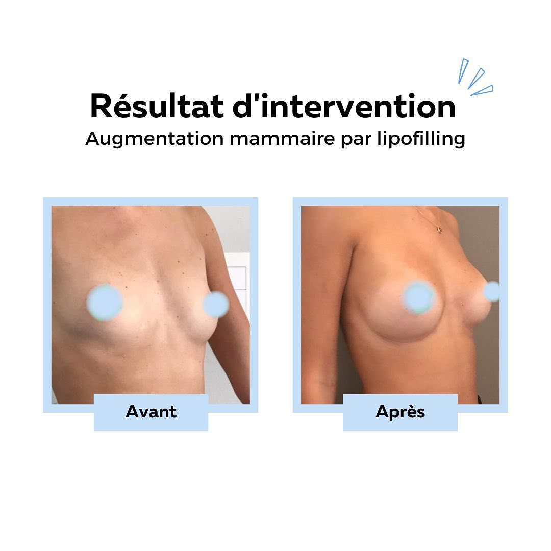 lipofilling-seins Lipofilling des seins, Nice, Philippe Letertre