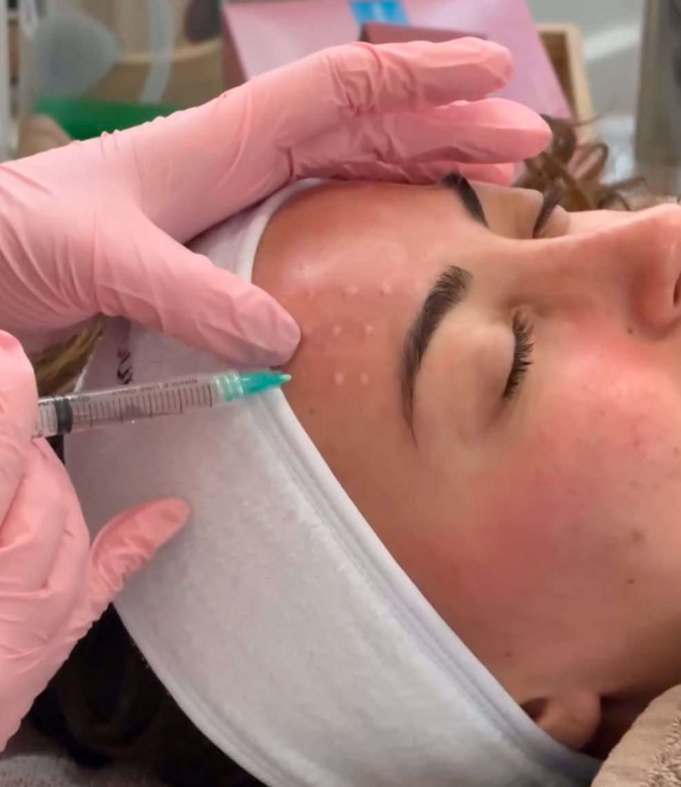mesotherapie Mésothérapie : hydrater, revitaliser et illuminer la peau