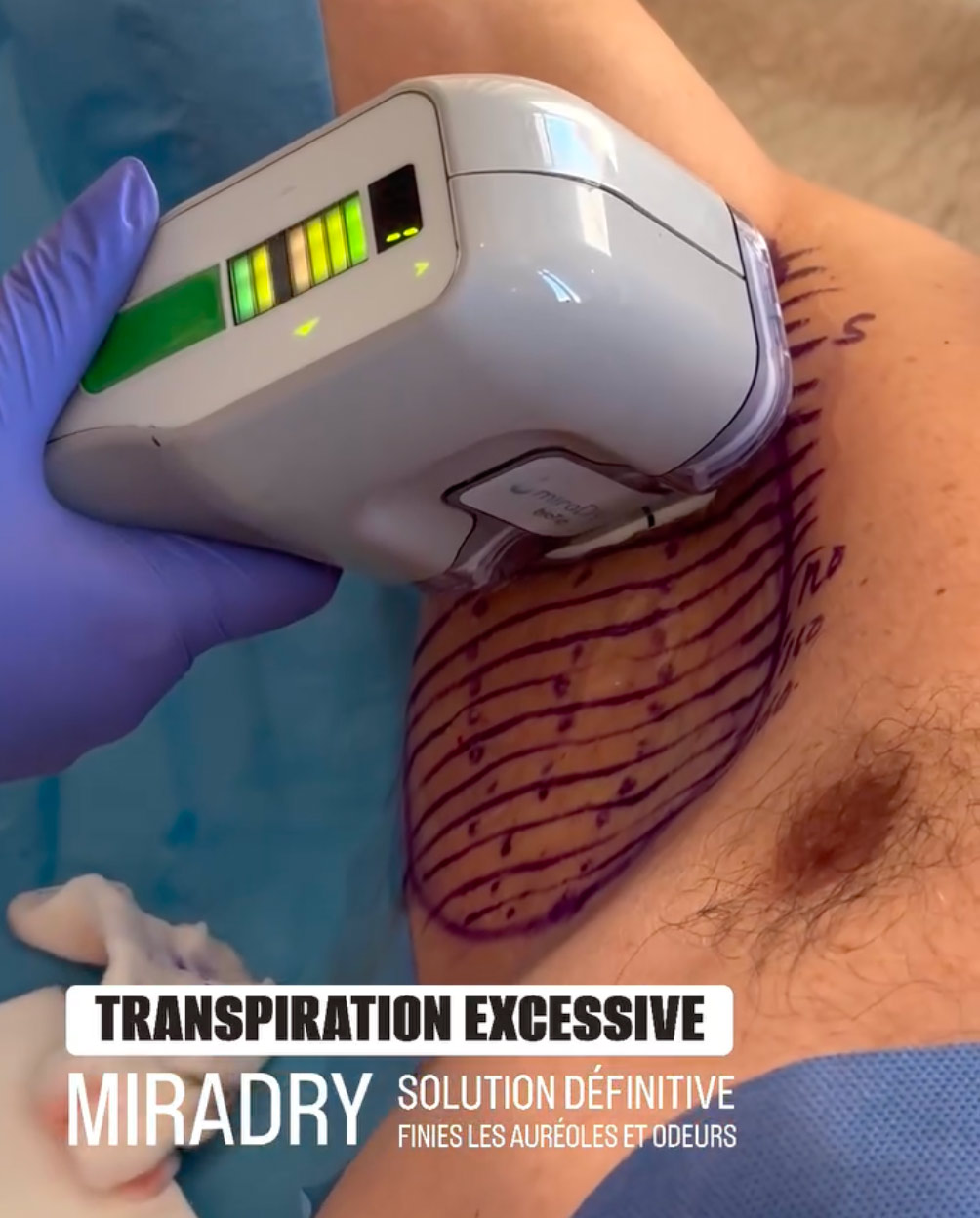 miraDry MiraDry, la solution définitive contre la transpiration des aisselles