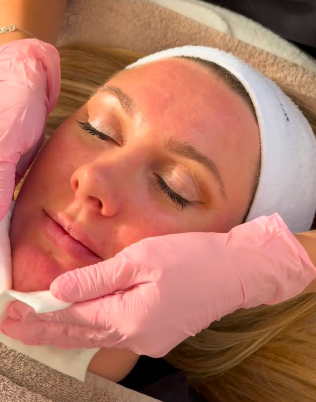 peeling Les peelings : révéler l’éclat de la peau