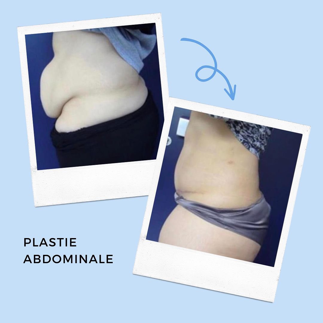 plastie-abdo-1 Plastie abdominale