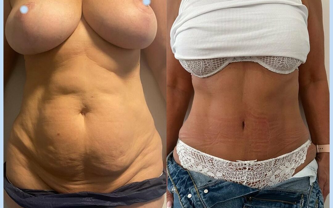 Plastie abdominale