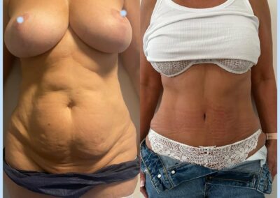 Plastie abdominale