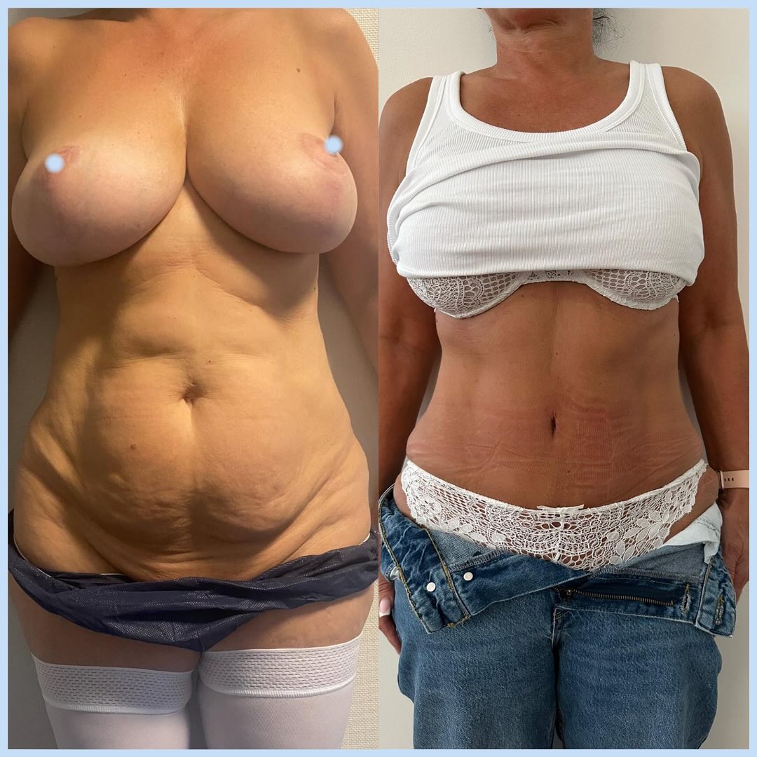 plastie-abdo-2 Plastie abdominale
