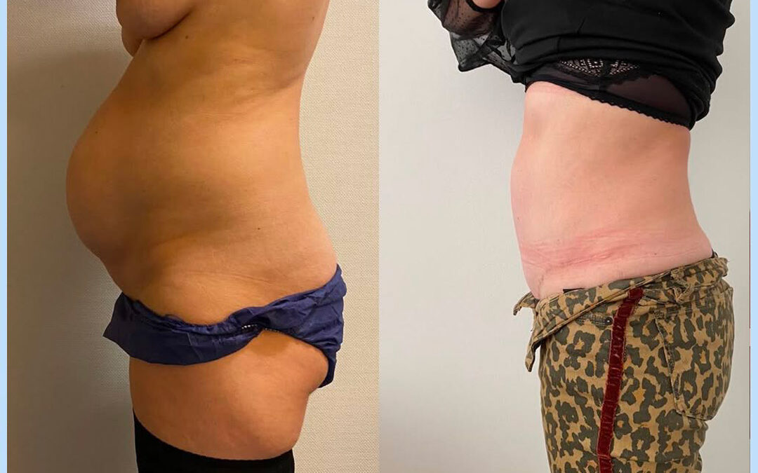 Plastie abdominale