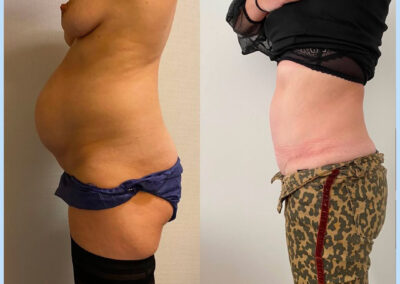 Plastie abdominale