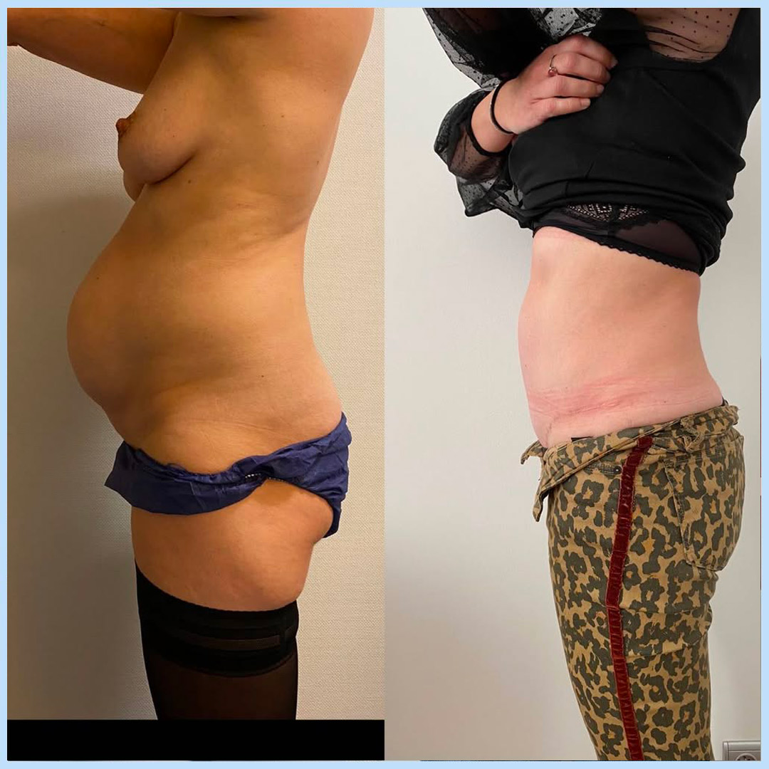 plastie-abdo-4 Plastie abdominale