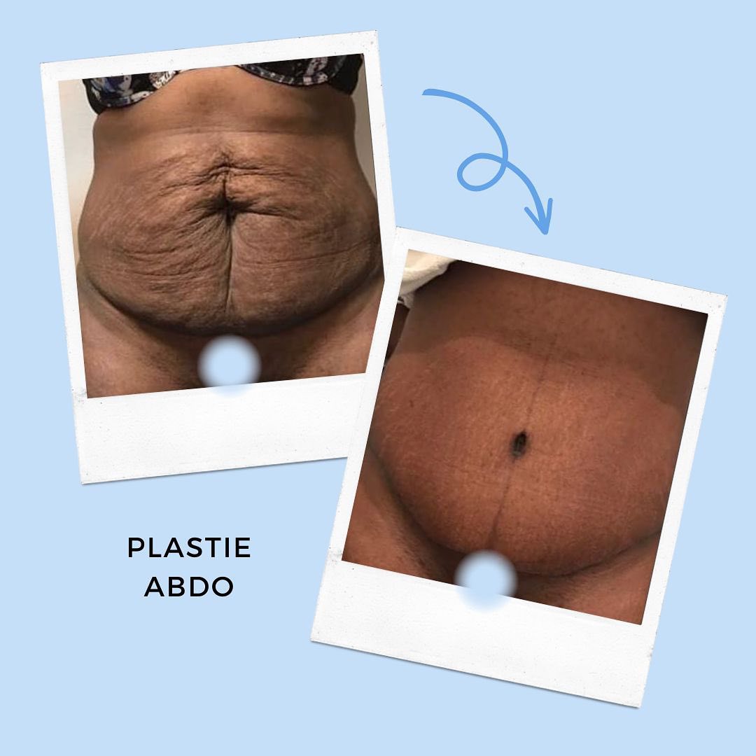 plastie-abdo-5 Plastie abdominale