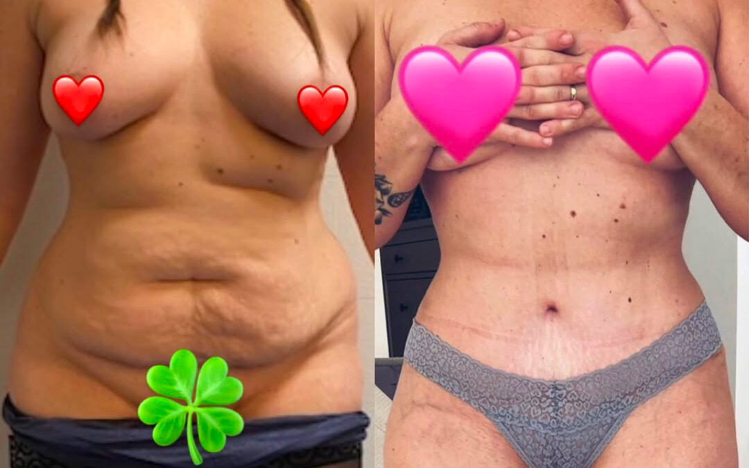 Plastie abdominale