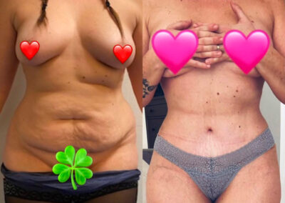 Plastie abdominale
