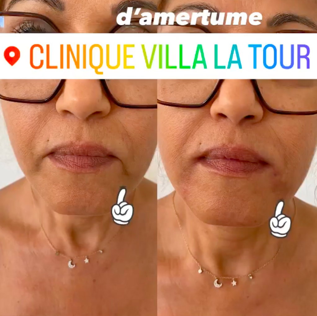 plis-amertume Plis d'amertume avec l'acide hyaluronique