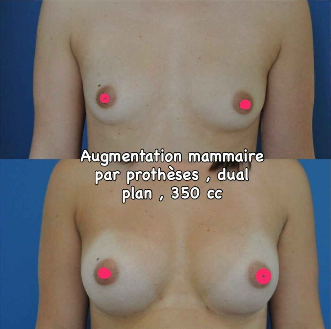 Augmentation mammaire par prothèses