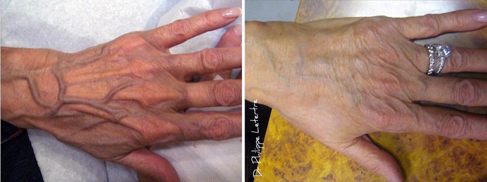 radiesse-1 Radiesse® et le rajeunissement des mains