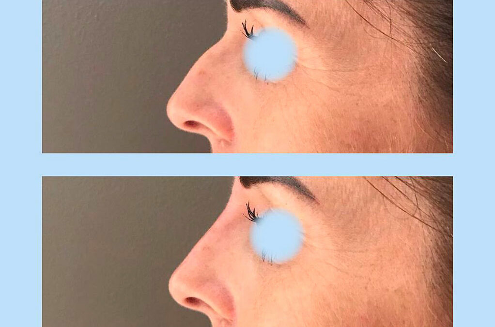 Rhinoplastie avec acide hyaluronique