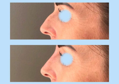 Rhinoplastie avec acide hyaluronique