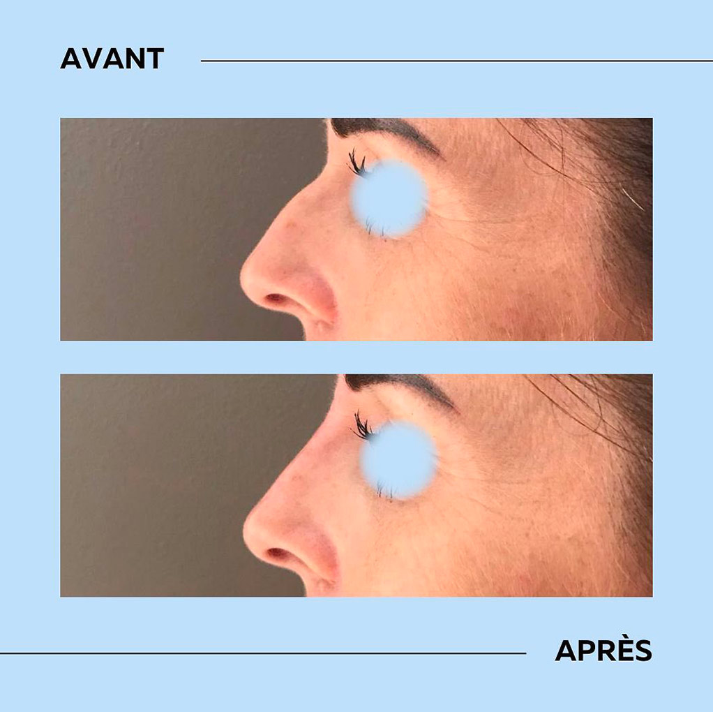 rhinoplastie-acide-hyaluronique Rhinoplastie avec injection acide hyaluronique