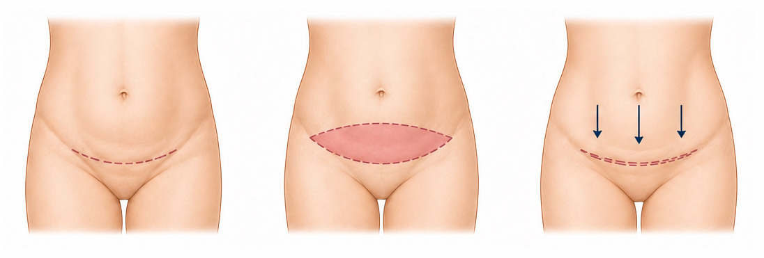 schema-mini-plastie Mini-plastie abdominale