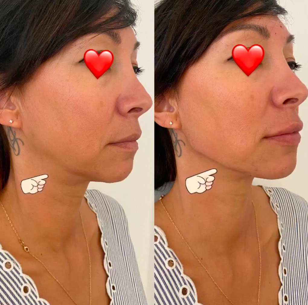 traitement-anti-age-acide-hyaluronique-1 restaurer les volumes d’un visage avec l'acide Hyaluronique