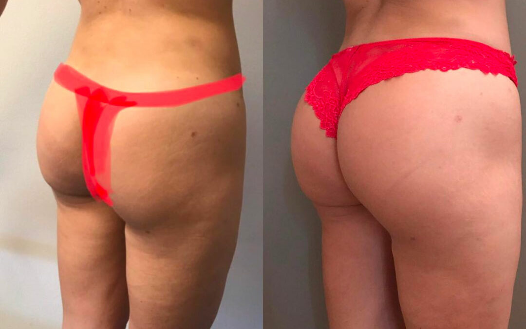 Lipofilling des fesses