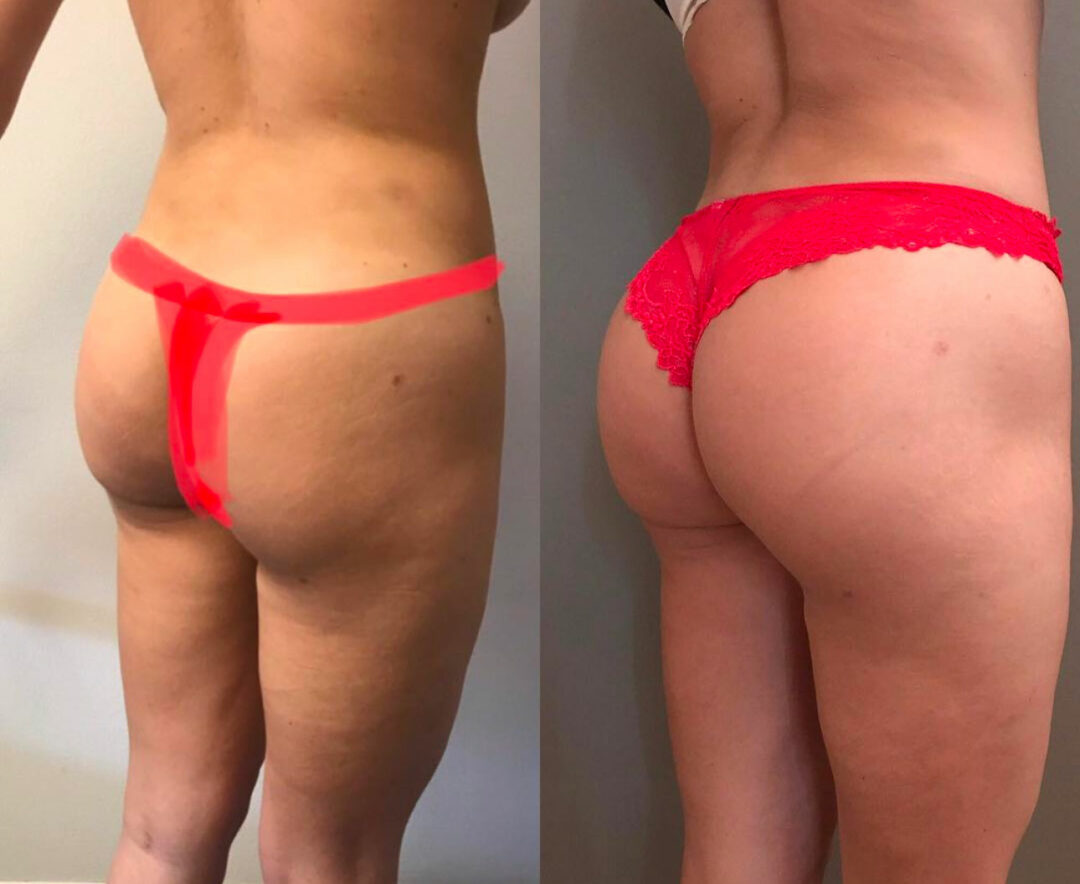 Lipofilling des fesses