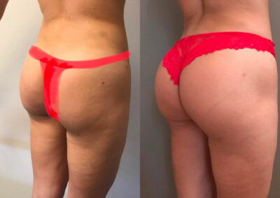 Lipofilling des fesses