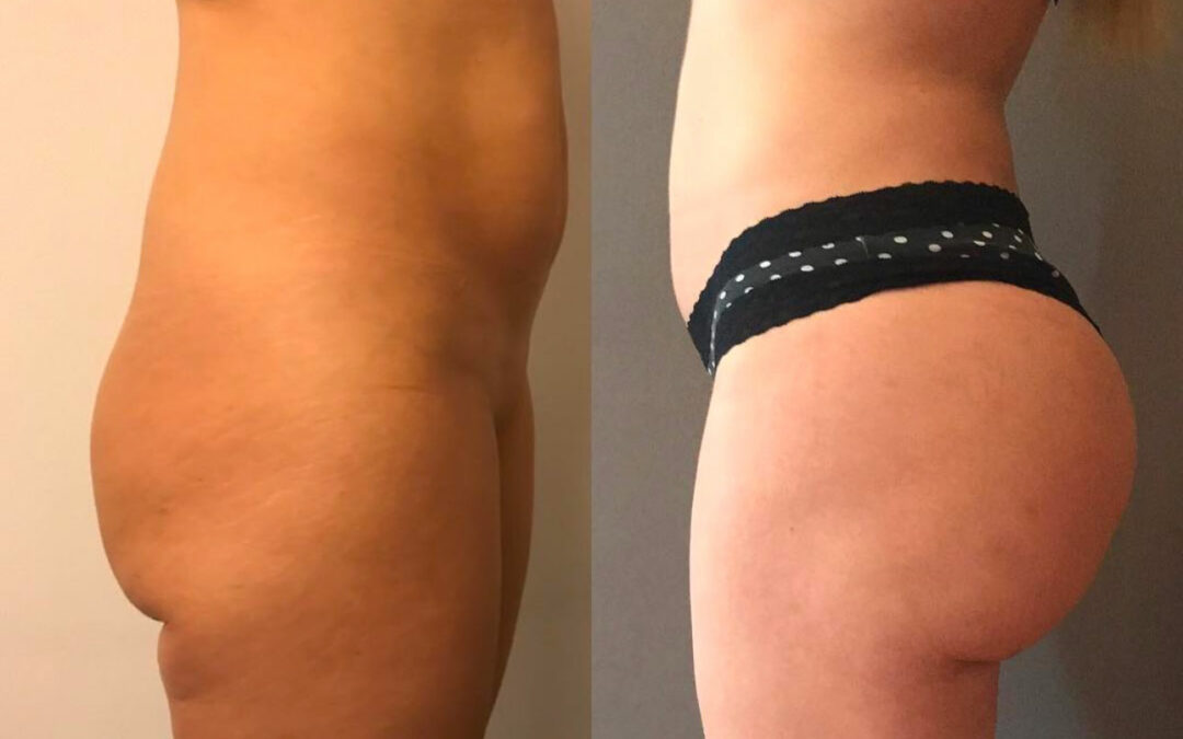 Lipofilling des fesses