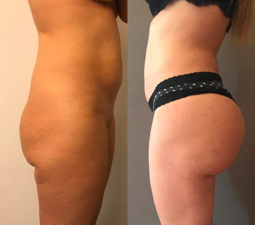 Lipofilling des fesses
